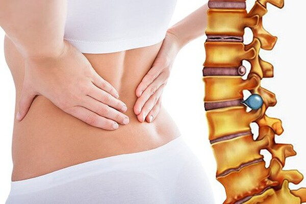 Thoái hóa cột sống có thể là nguyên nhân gây ra triệu chứng ho đau lưng